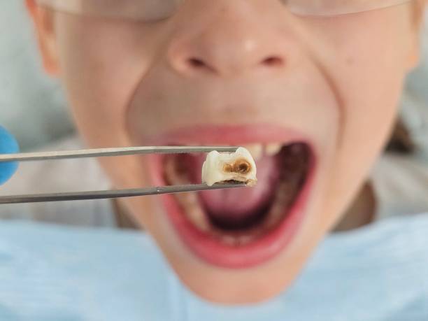 Best Knocked-Out Tooth (Avulsed Tooth) Treatment in Coeburn, VA